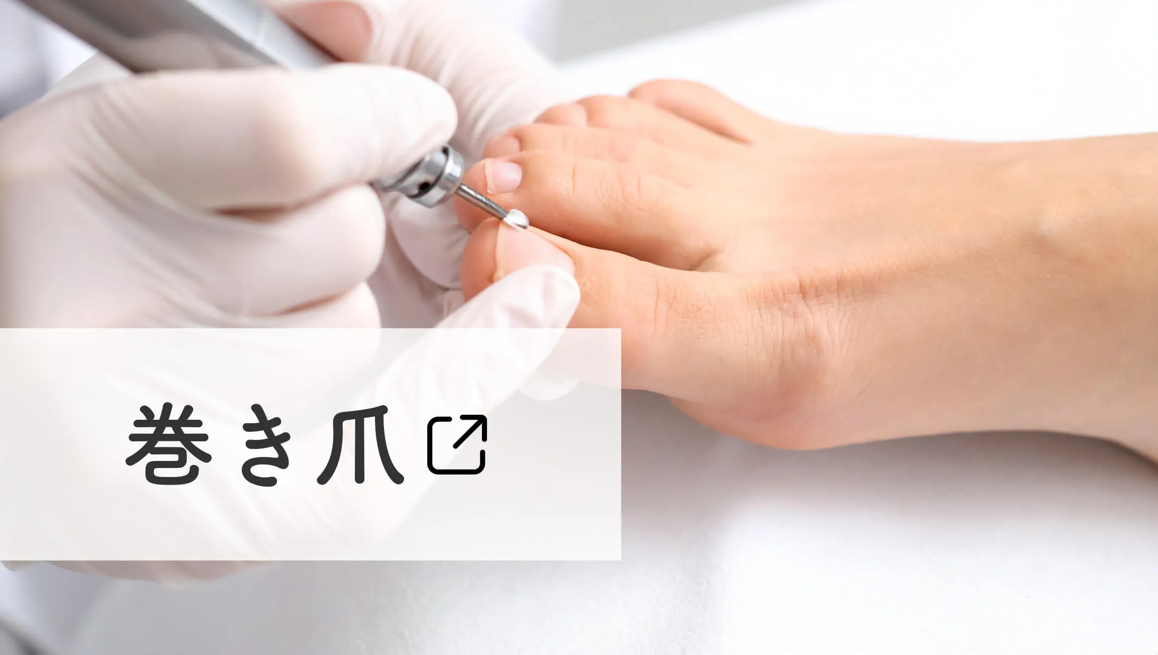 巻き爪