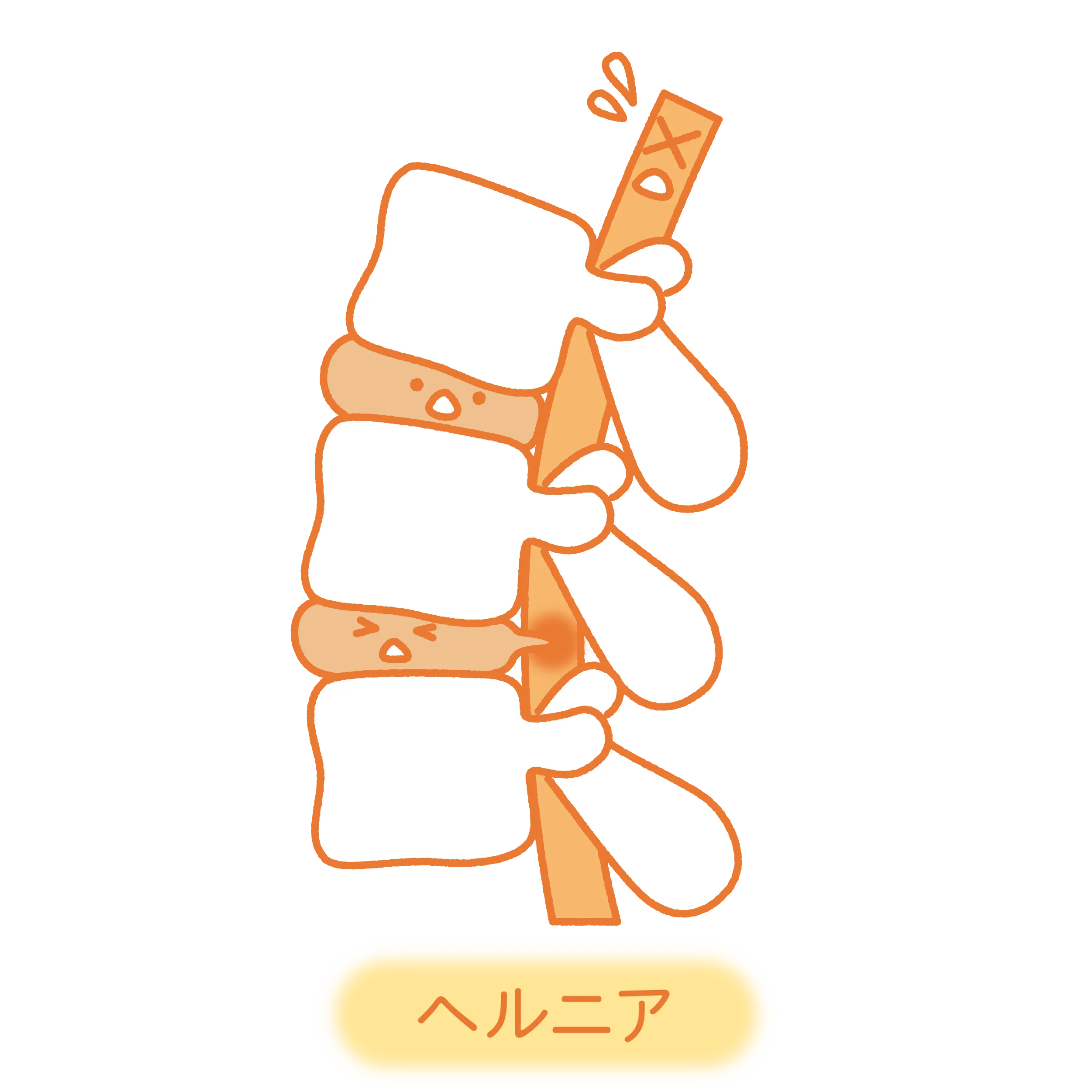 椎間板ヘルニア