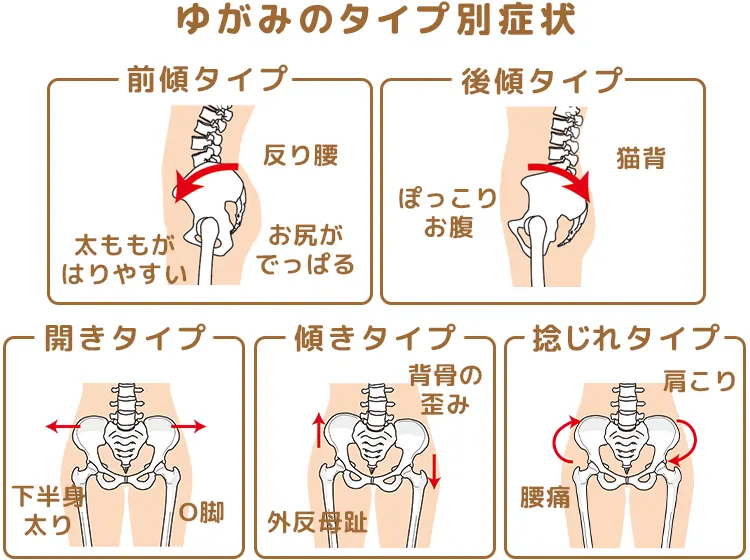 骨盤のゆがみタイプ